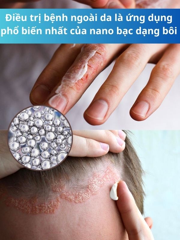 Kem bôi nano bạc có an toàn cho bé khi trị bệnh ngoài da không